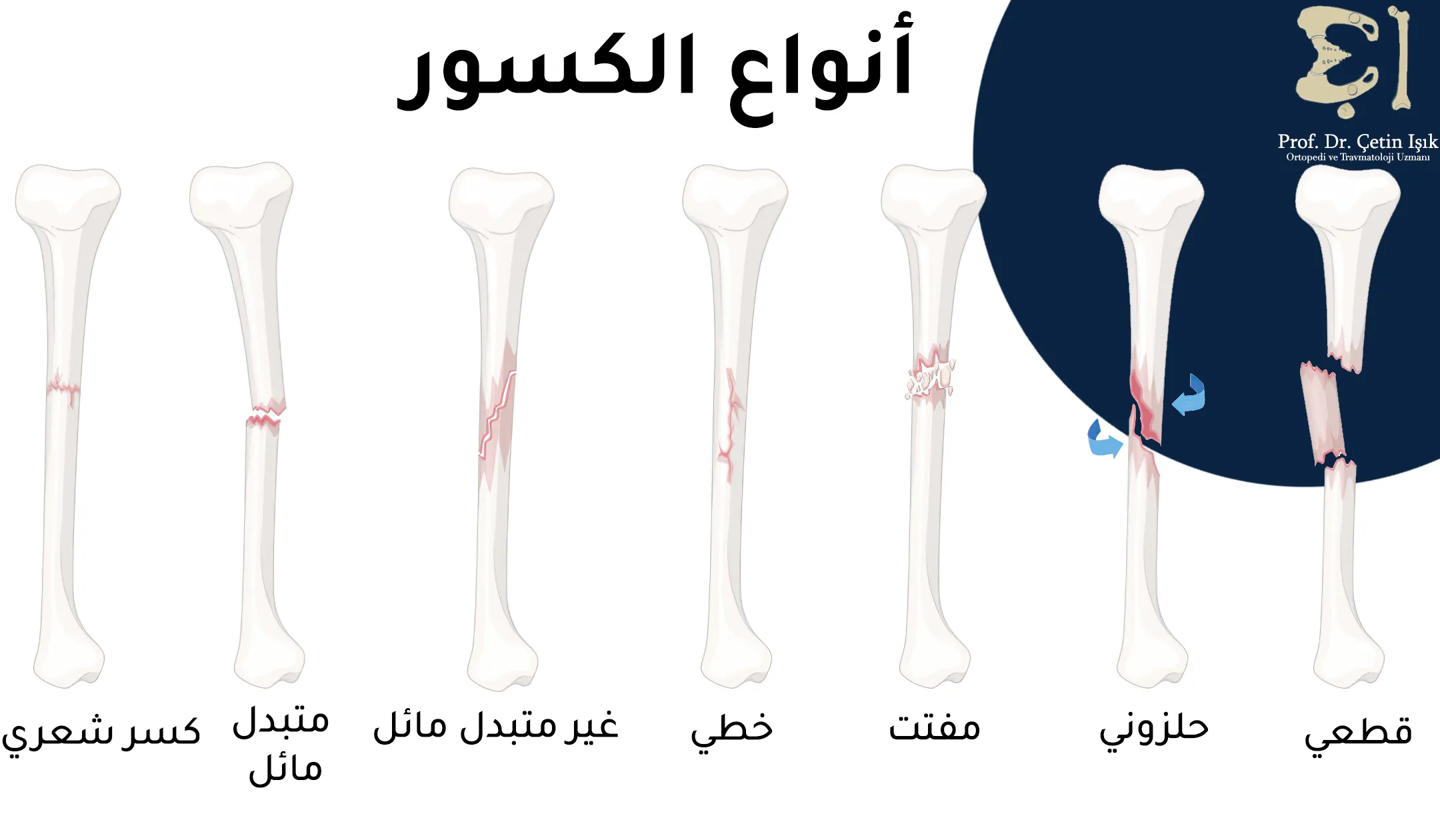 هنالك سبع أنواع لكسور الساق وهي الكسر القطعي والحلزوني والمفتت والخطي والكسر الشعري والكسر المتبدل أو غير المتبدل
