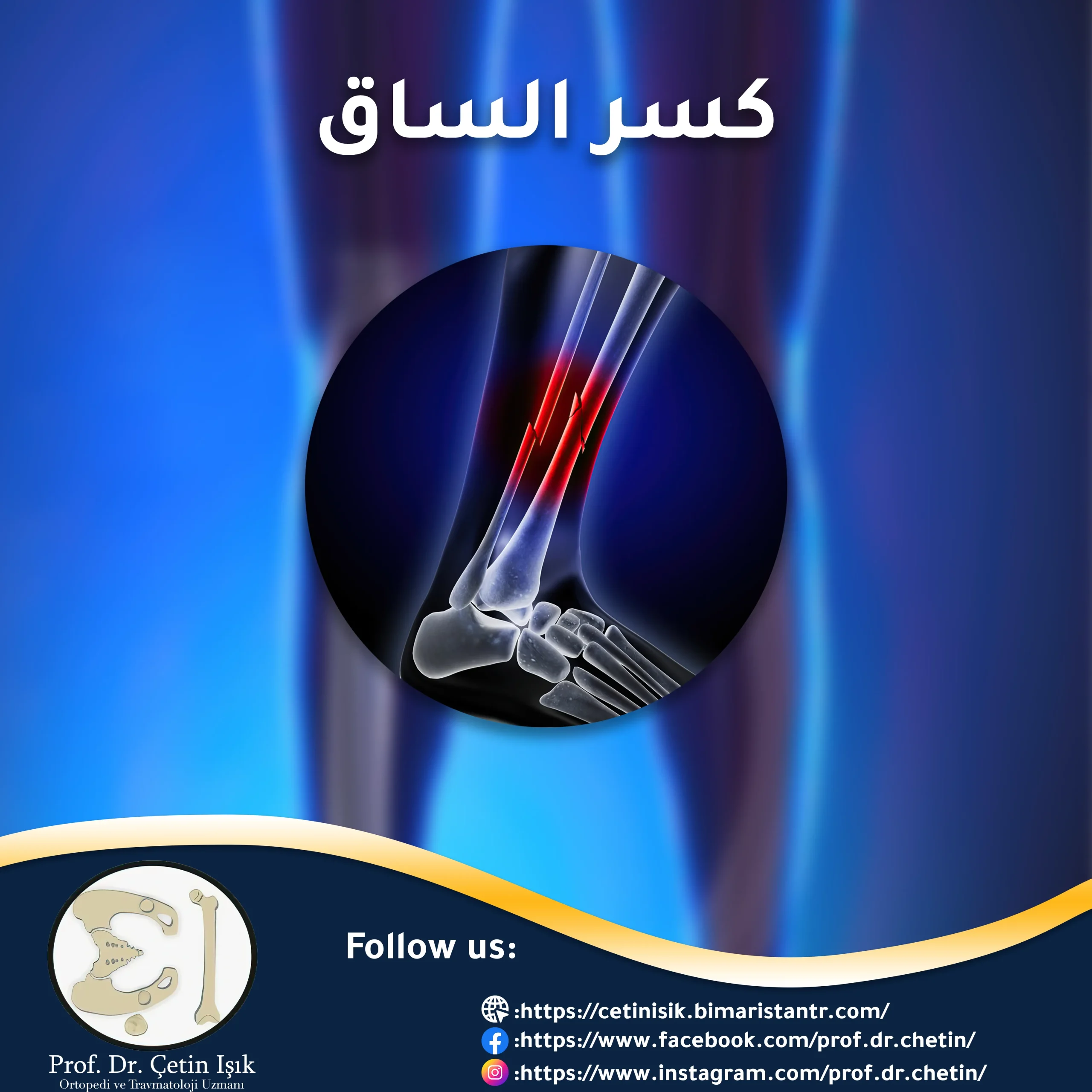 leg fracture how to determine its type and methods of treatment