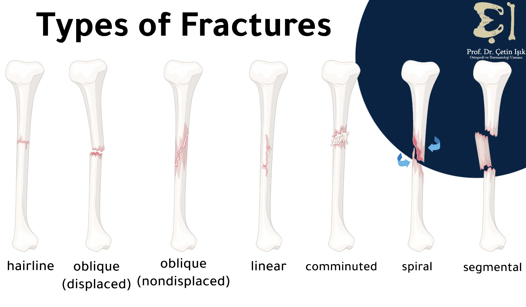 There are seven types of leg fractures: segmental, spiral, comminuted, linear, hairline, and altered or non-altered fractures.