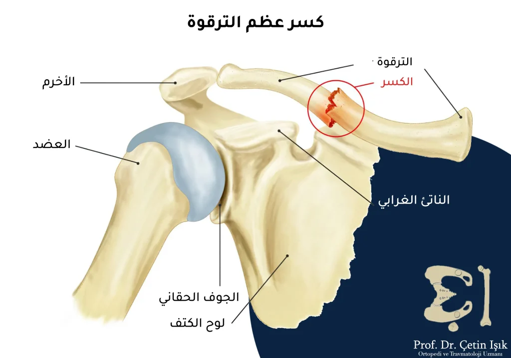 تظهر الصورة تشريح الكتف ومكان أغلب الإصابات عند الكسر؛ وهو منتصف الترقوة