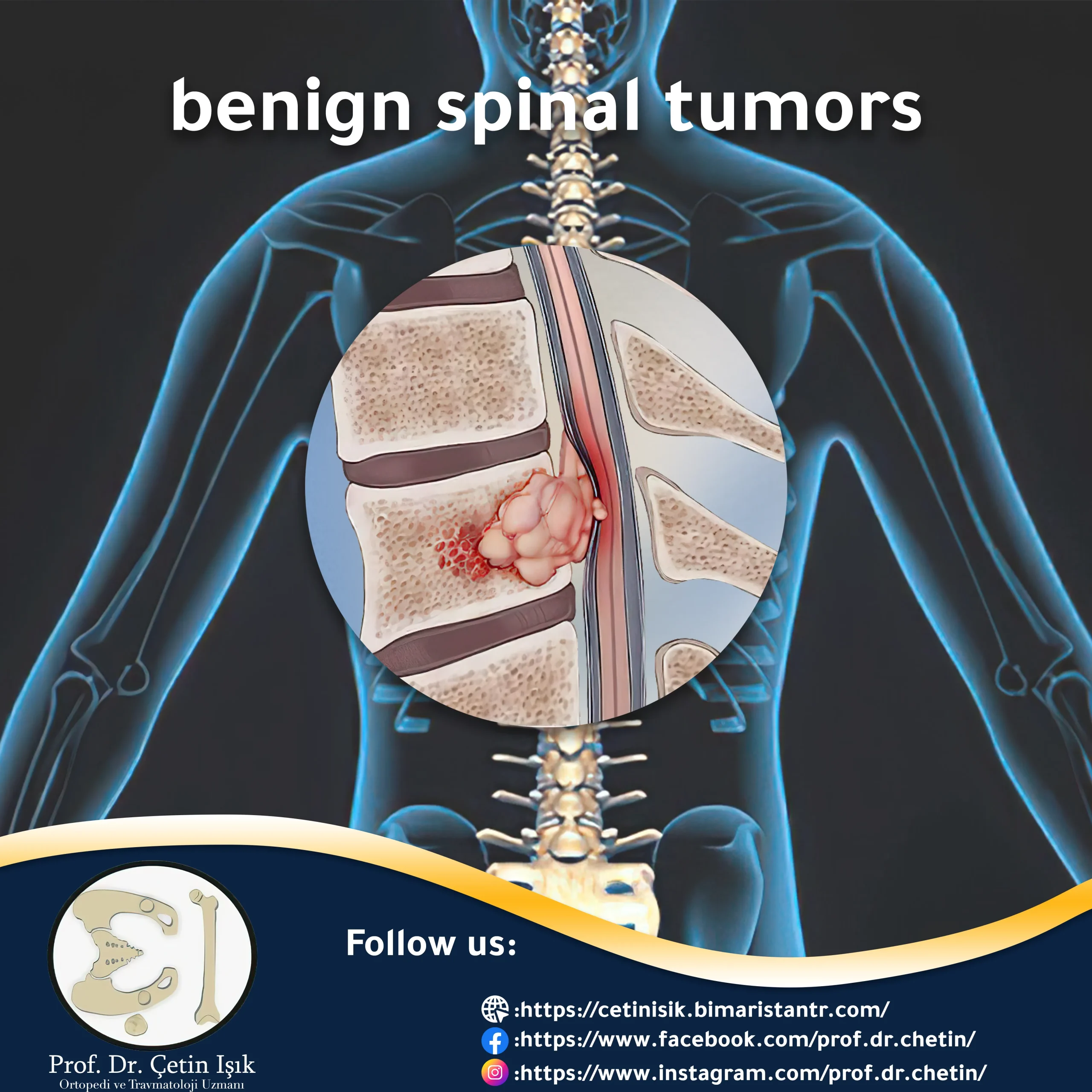 Benign spinal tumors and methods of treatment