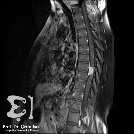 Magnetic resonance imaging shows the narrowing of the spinal cord 