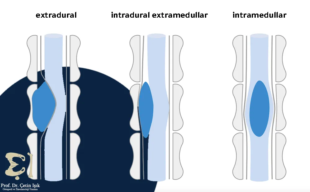 We notice from the picture the places where benign spinal tumors are located, as they may be located inside the spinal cord, outside the spinal cord, within the dura, or outside the dura.