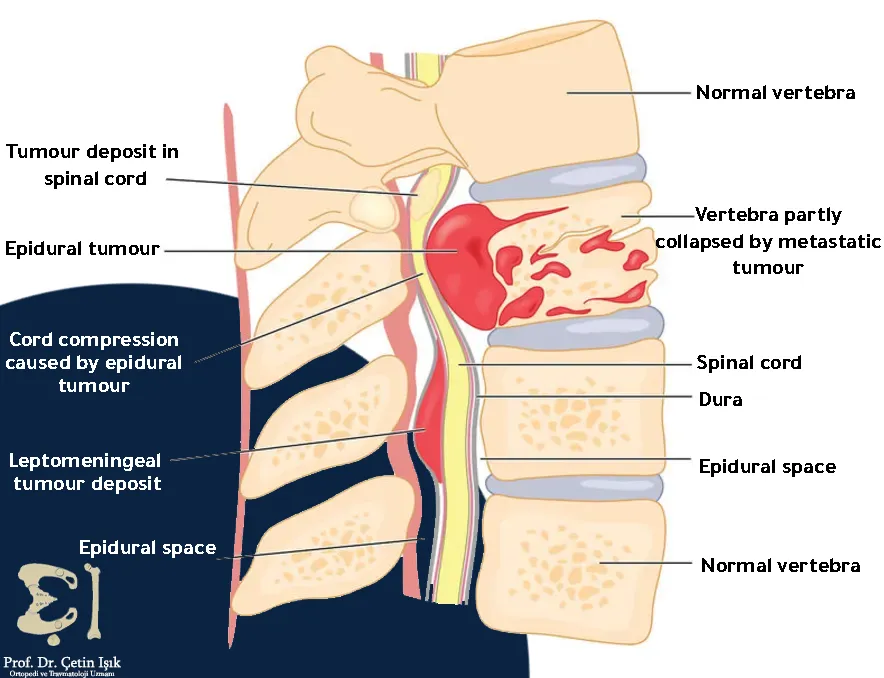 We note from the picture that the symptoms of benign spinal tumors are related to the tumor's location, as it may cause osteoporosis or pressure on the spinal cord.