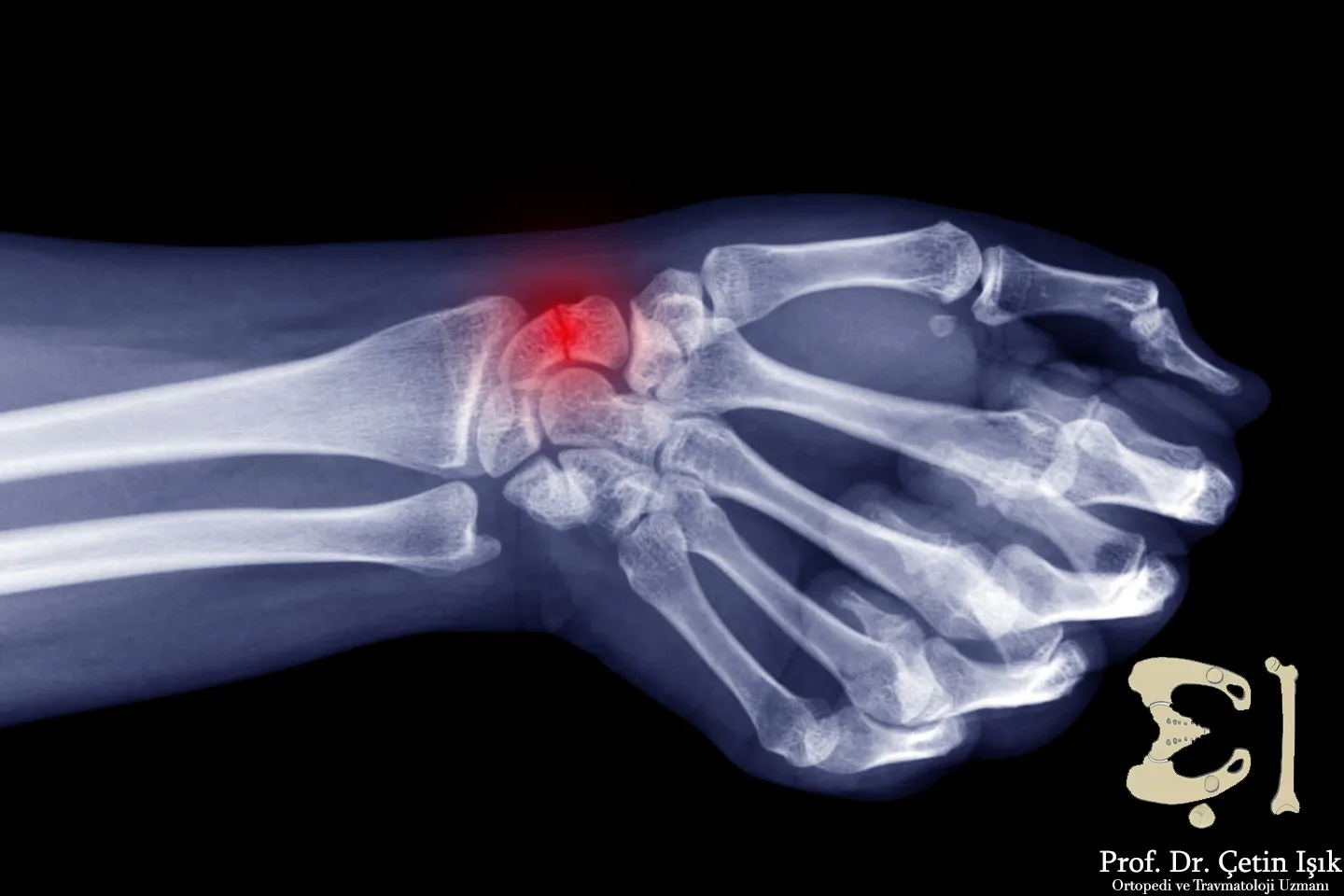 صورة شعاعية لليد نلاحظ من خلالها وجود كسر غير متبدل في العظم الزورقي داخل مفصل اليد