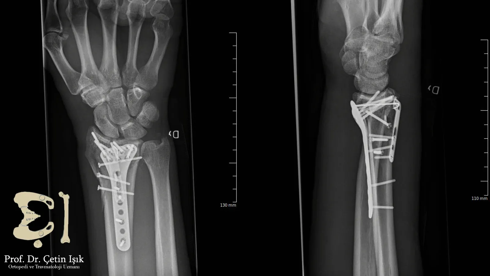 Anterior and lateral radiograph showing plates placed on the lower end of the radial bone and secured with screws (internal fixation surgery)