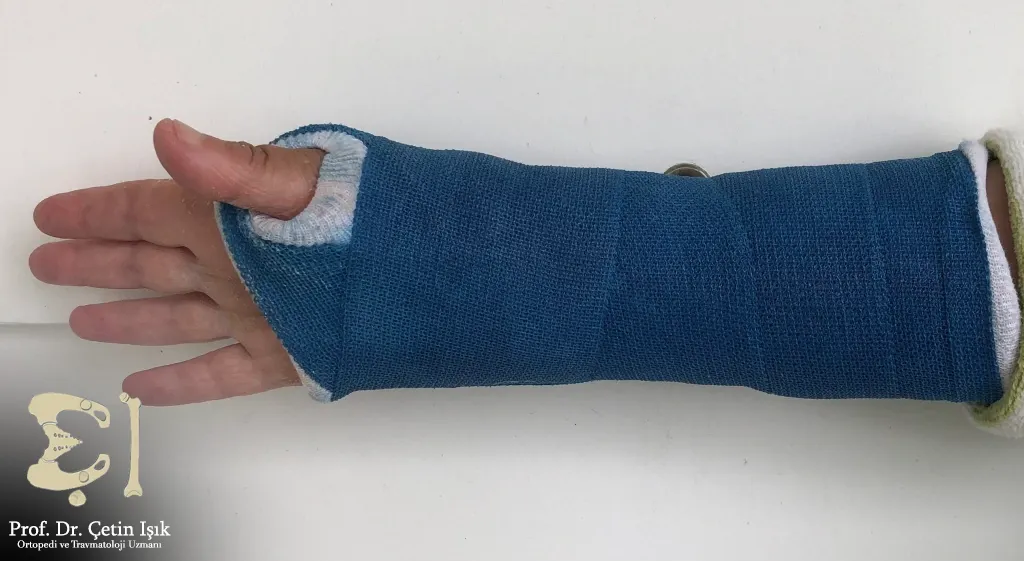 We notice from the picture that the hand joint fracture splint is placed from the middle of the palm to the middle of the forearm, with the fingers of the hand outstretched