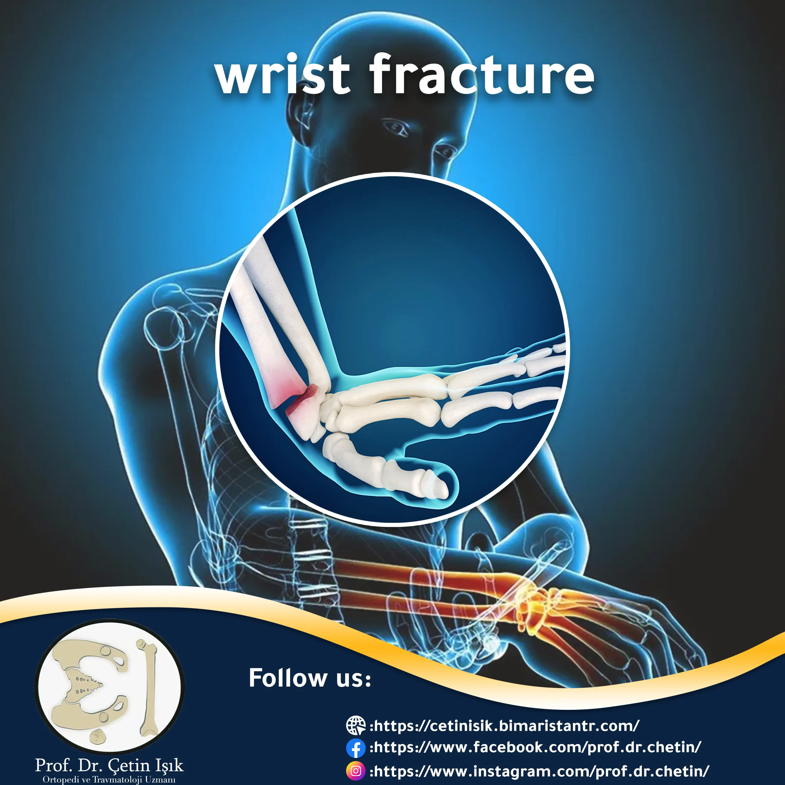 wrist fracture, how to diagnose it, and methods of treatment