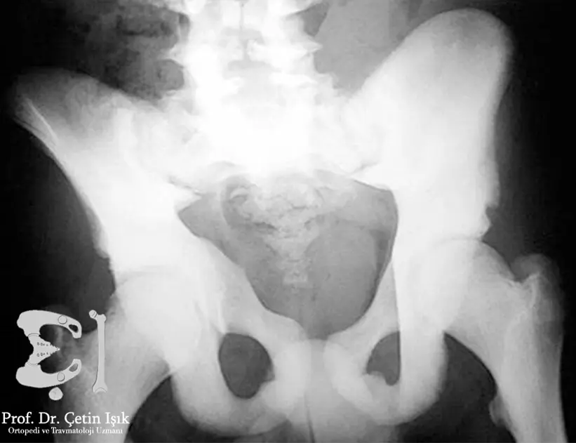 From the radiograph, we notice the presence of bone density in the pelvic bone due to sclerosis