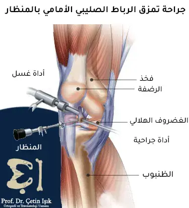 An image showing arthroscopy of the knee, in addition to the components of the knee joint