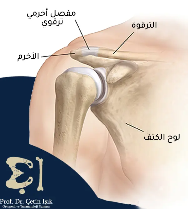 Picture of the components of the shoulder joint from the clavicle, the acromion, and the clavicular-acromial joint, and around this joint there are ligaments