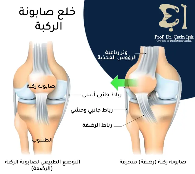 Image showing the external deviation of the kneecap as a result of damage to the lateral ligaments