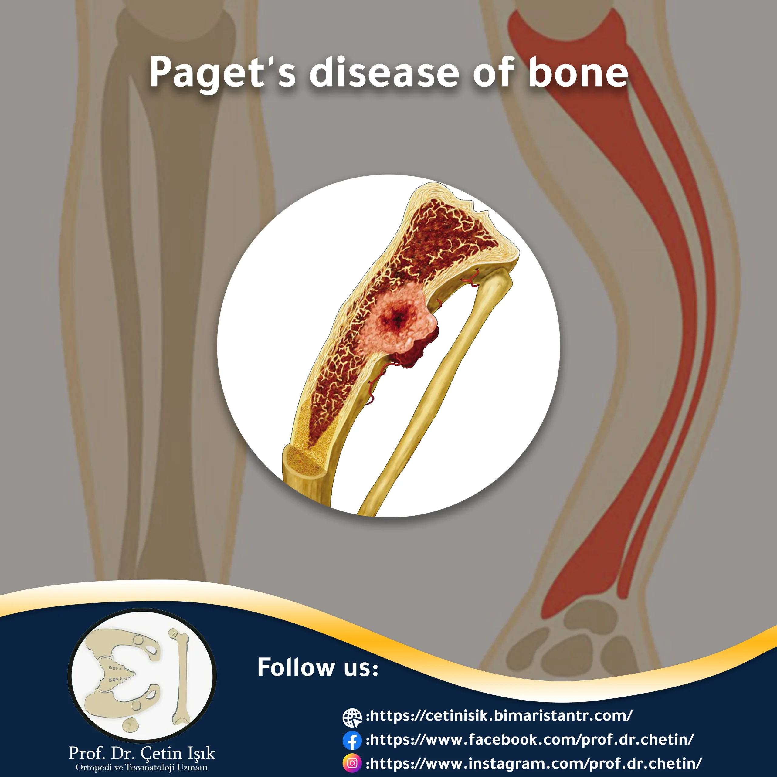 Paget Disease of the Bone