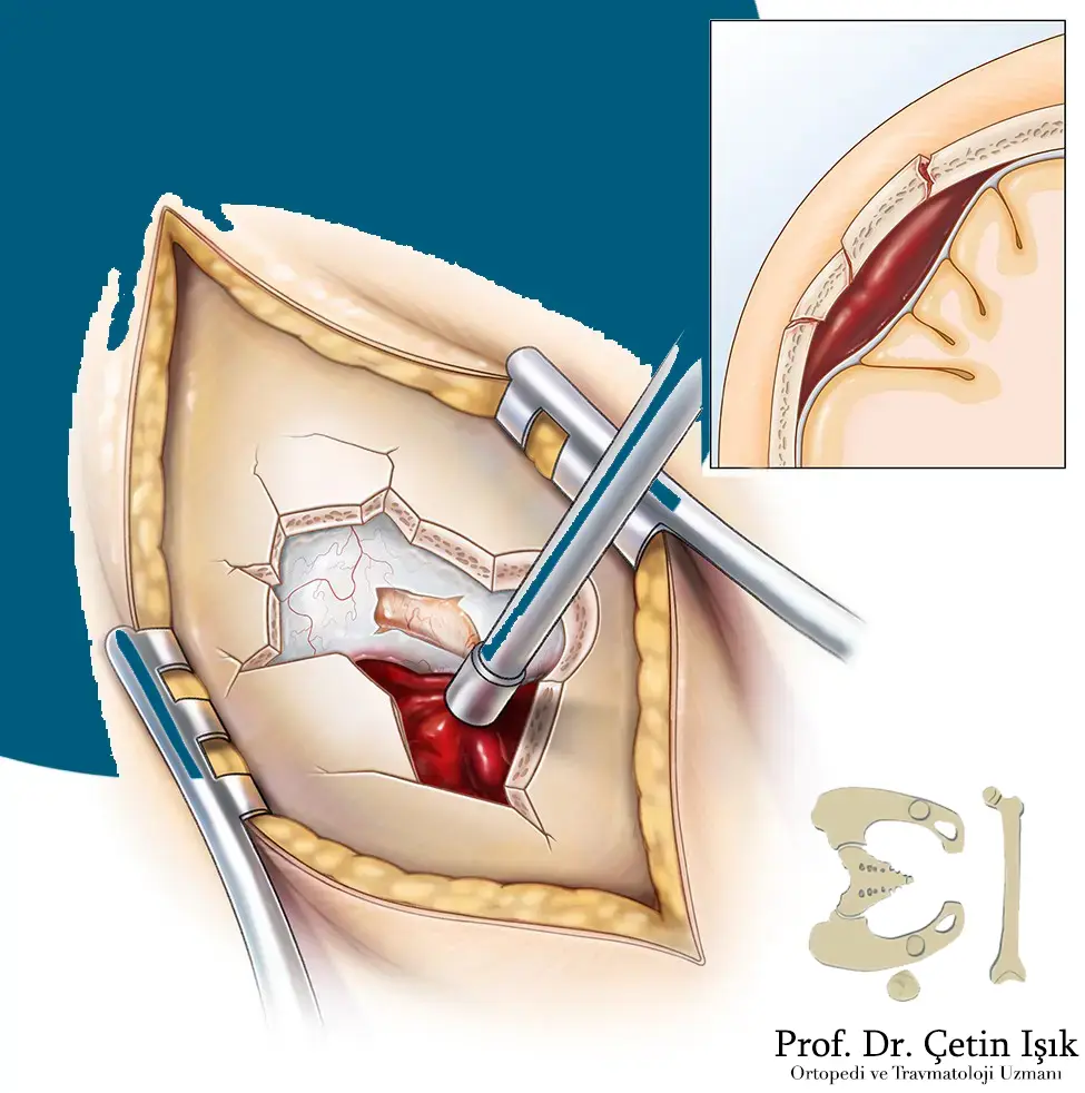 نلاحظ من الصورة علاج شرخ الجمجمة عند الكبار بالجراحة بسبب وجود تجمع دموي داخل القحف