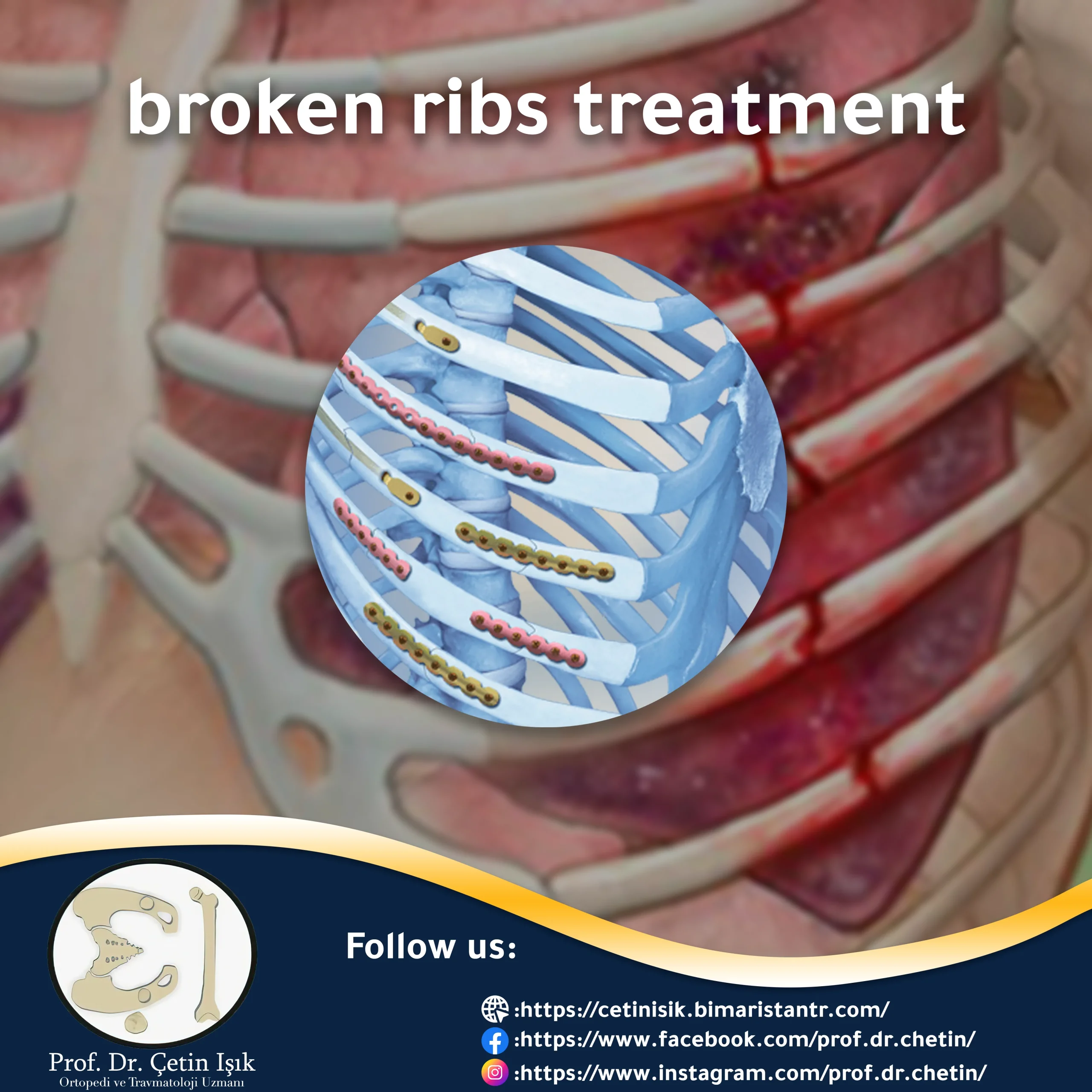 Rib fracture treatment - conservative or surgical - Prof. Dr. Çetin Işık