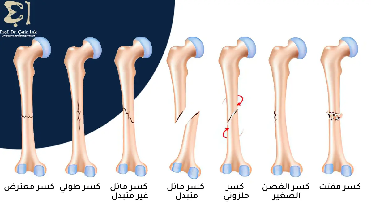 Image showing the various types of femoral body fracture