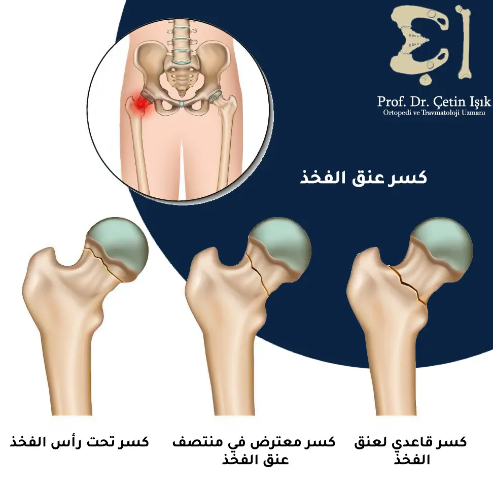 Image showing the patterns of femoral neck fracture according to the location of the fracture, basilar, subcapital, and mid-neck