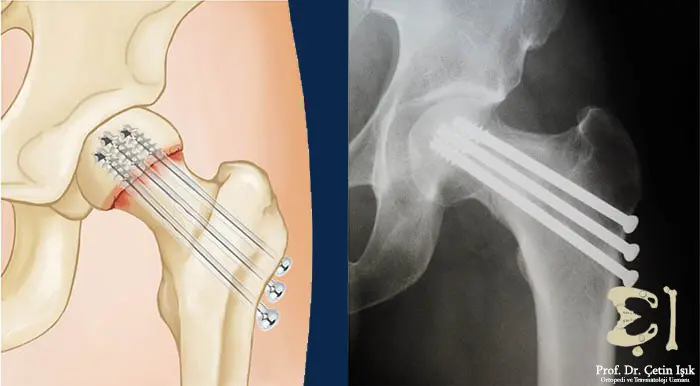 Treatment of femoral neck fracture with internal fixation using three parallel screws