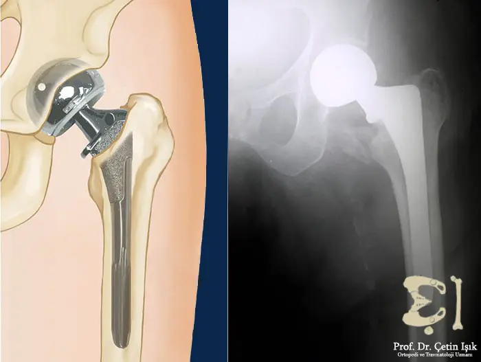treatment of femoral neck fracture with partial hip replacement; In it, the doctor replaces the upper part of the femur and replaces it with an artificial head and neck