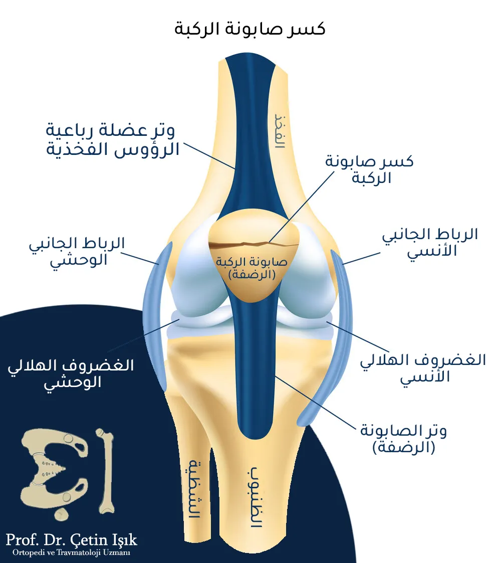 An image showing the components of the knee joint. At the top is the thigh, and at the bottom are the tibia and fibula. In the middle is the knee cap on which the quadriceps femoris and the patellar tendon rest. We also see the meniscus and knee ligaments.