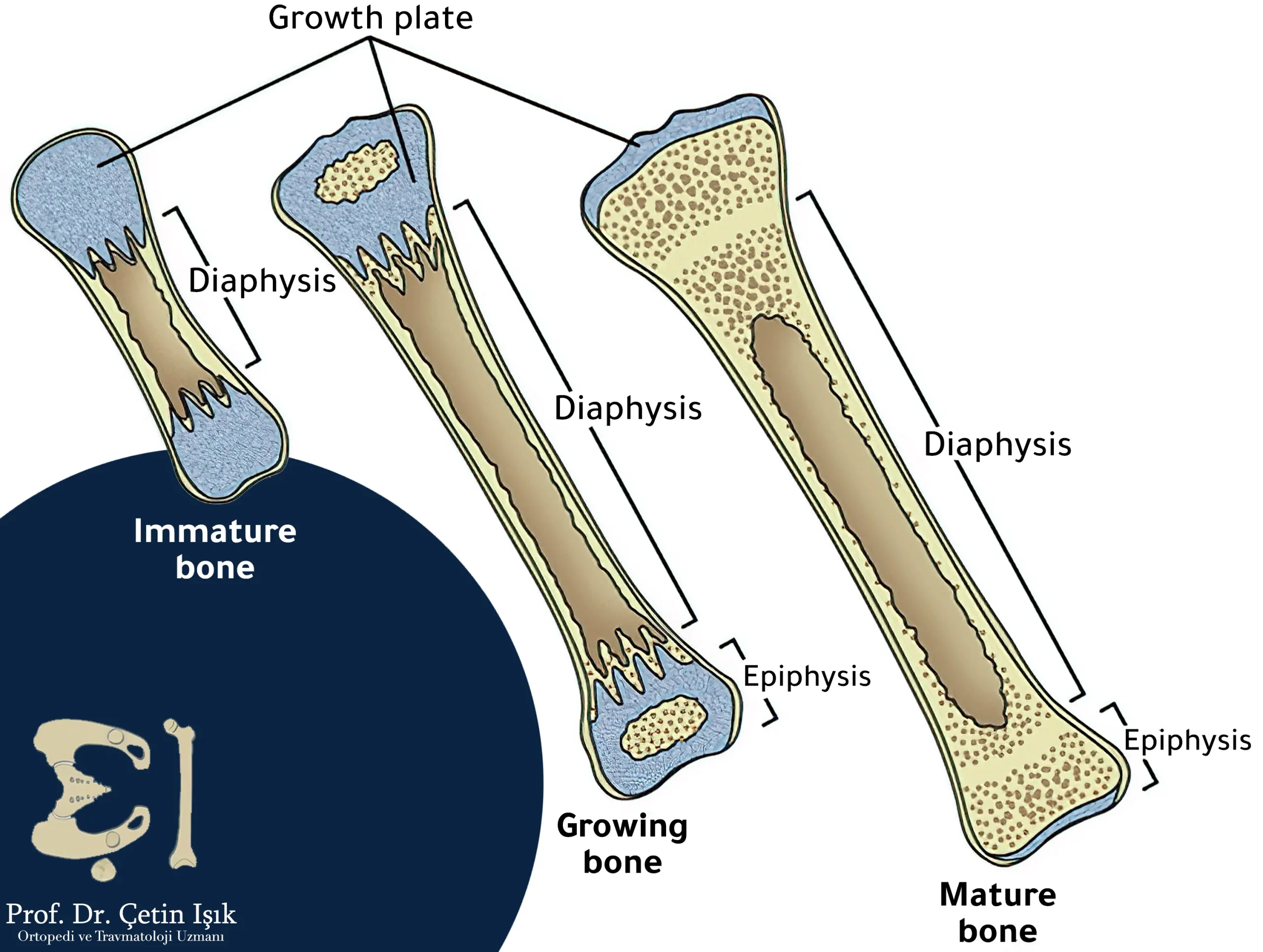 Bone types can be classified in terms of Microscopic examination into an immature primary bone in the embryonic stage that is replaced by a mature secondary bone at puberty.