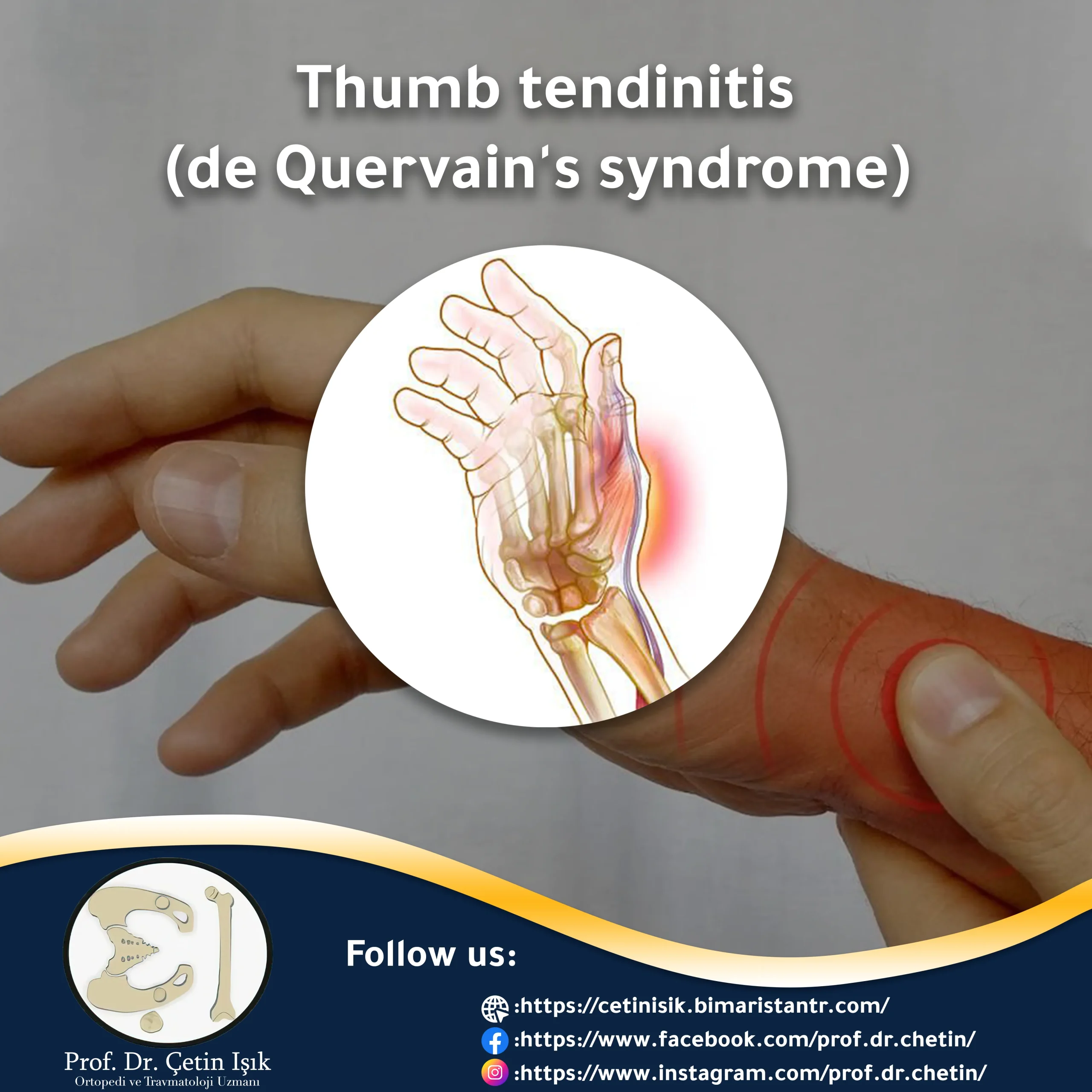 Thumb tendinitis article image
