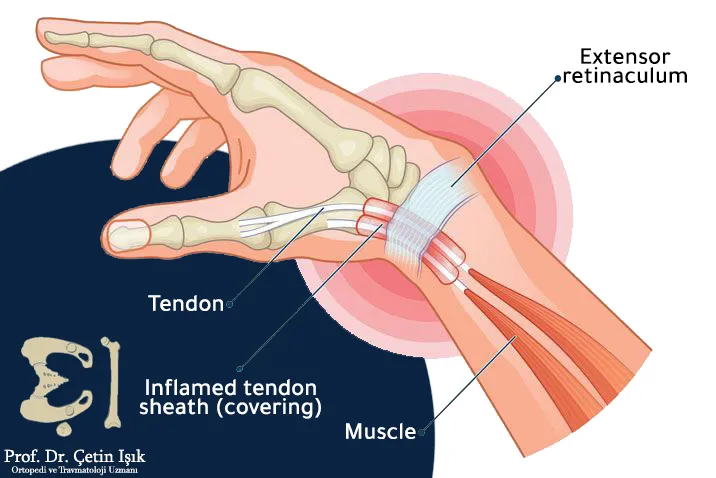 Drawing showing the placement of the tendons of the thumb on the medial side of the wrist and their passage through the condyle of the extensors.