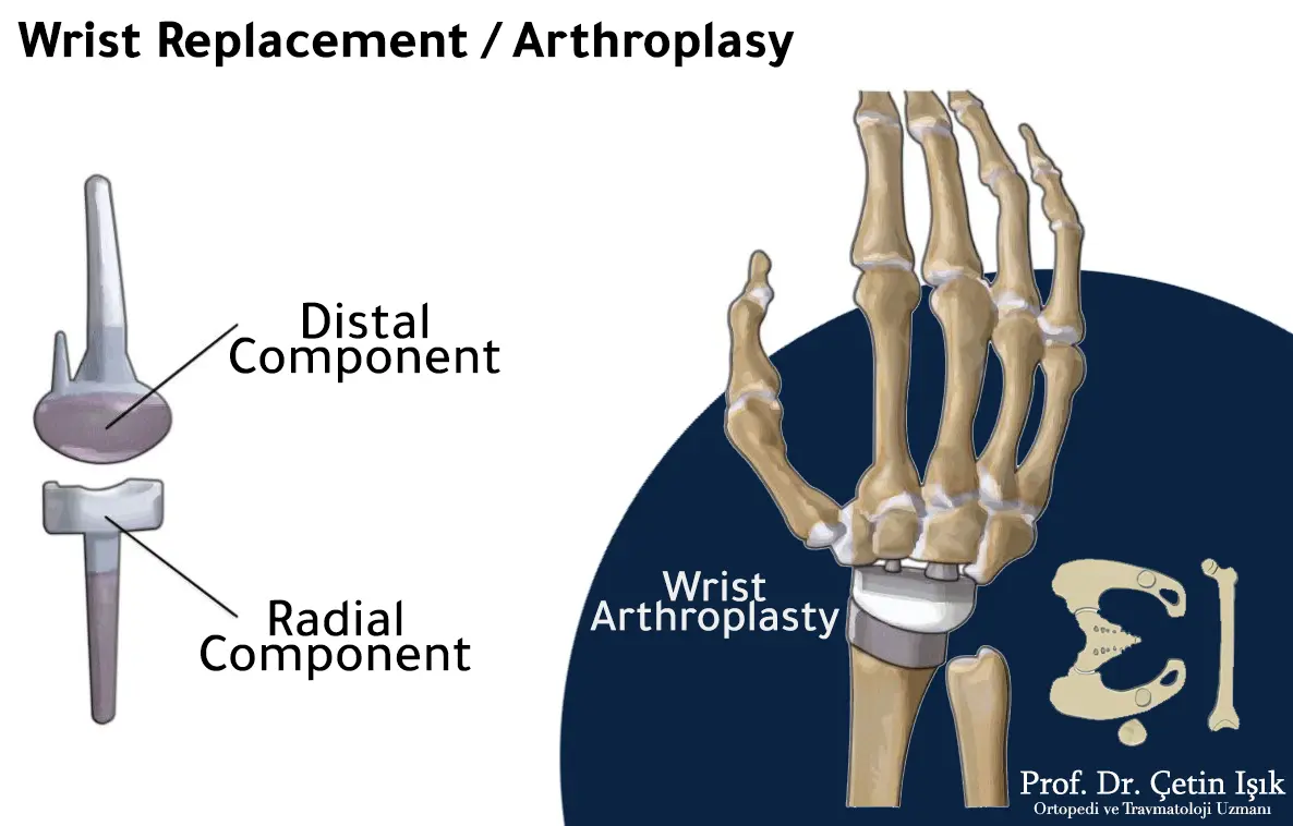 Wrist replacement includes two components, the distal part and the radial part