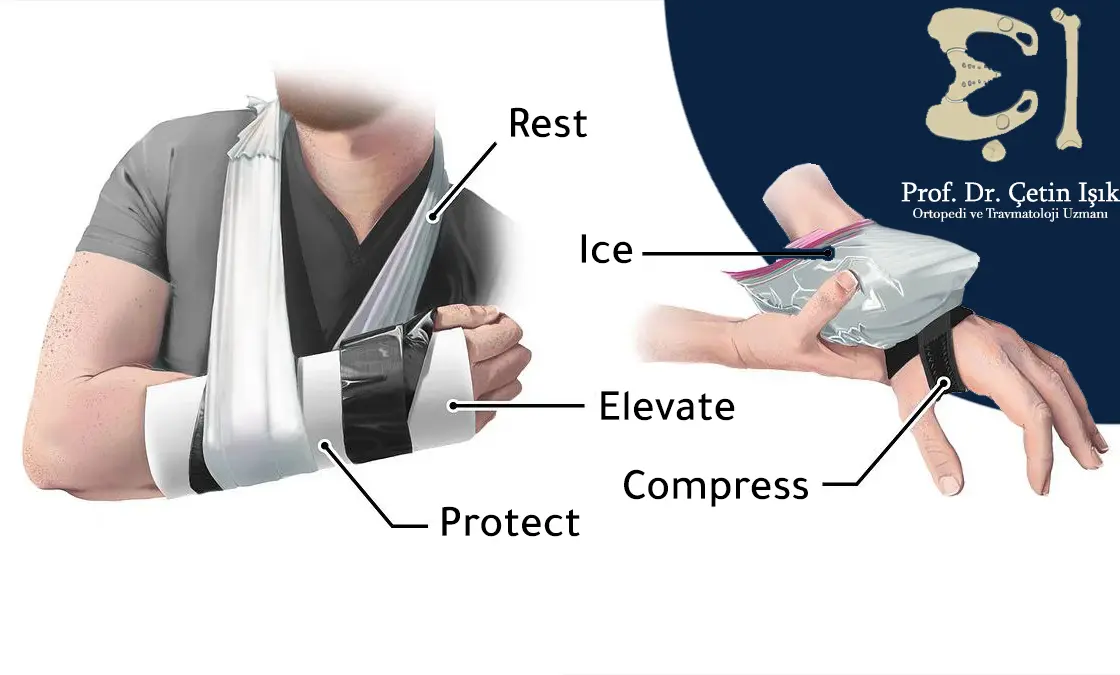 Therapeutic measures for a hand joint sprain include: rest, arm elevation, ice packs, compression application and hand protection