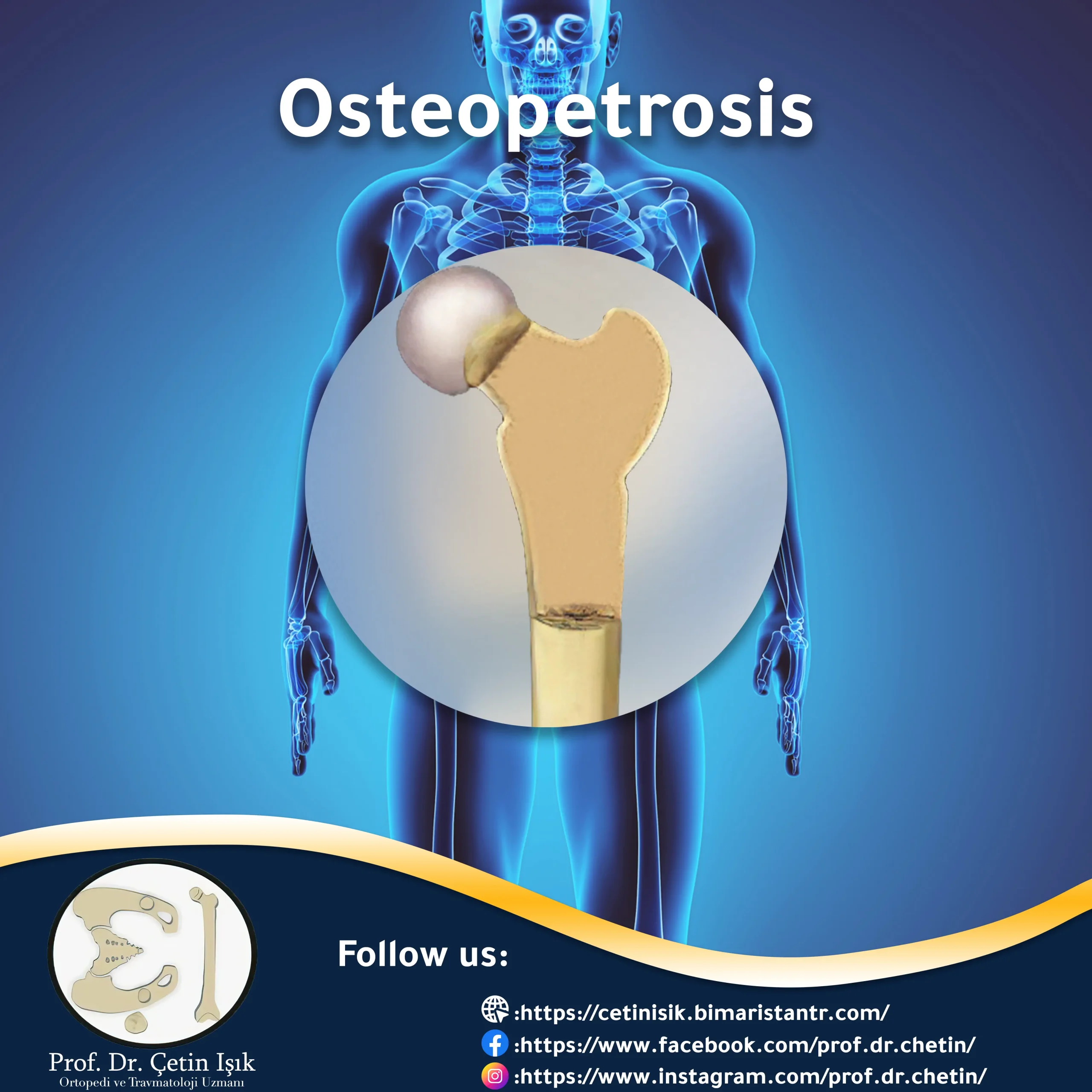 Osteoarthritis - how it occurs and the most important methods of treatment
