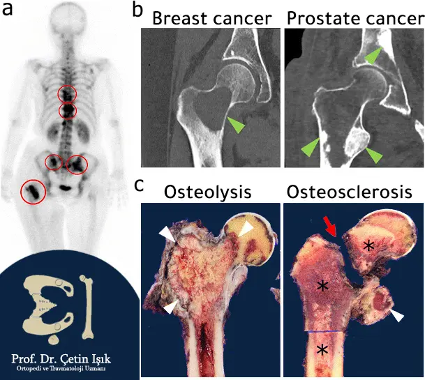 From the picture, we note the incidence of acquired sclerosis due to the formation of cancerous metastases in the bones from breast cancer and prostate cancer