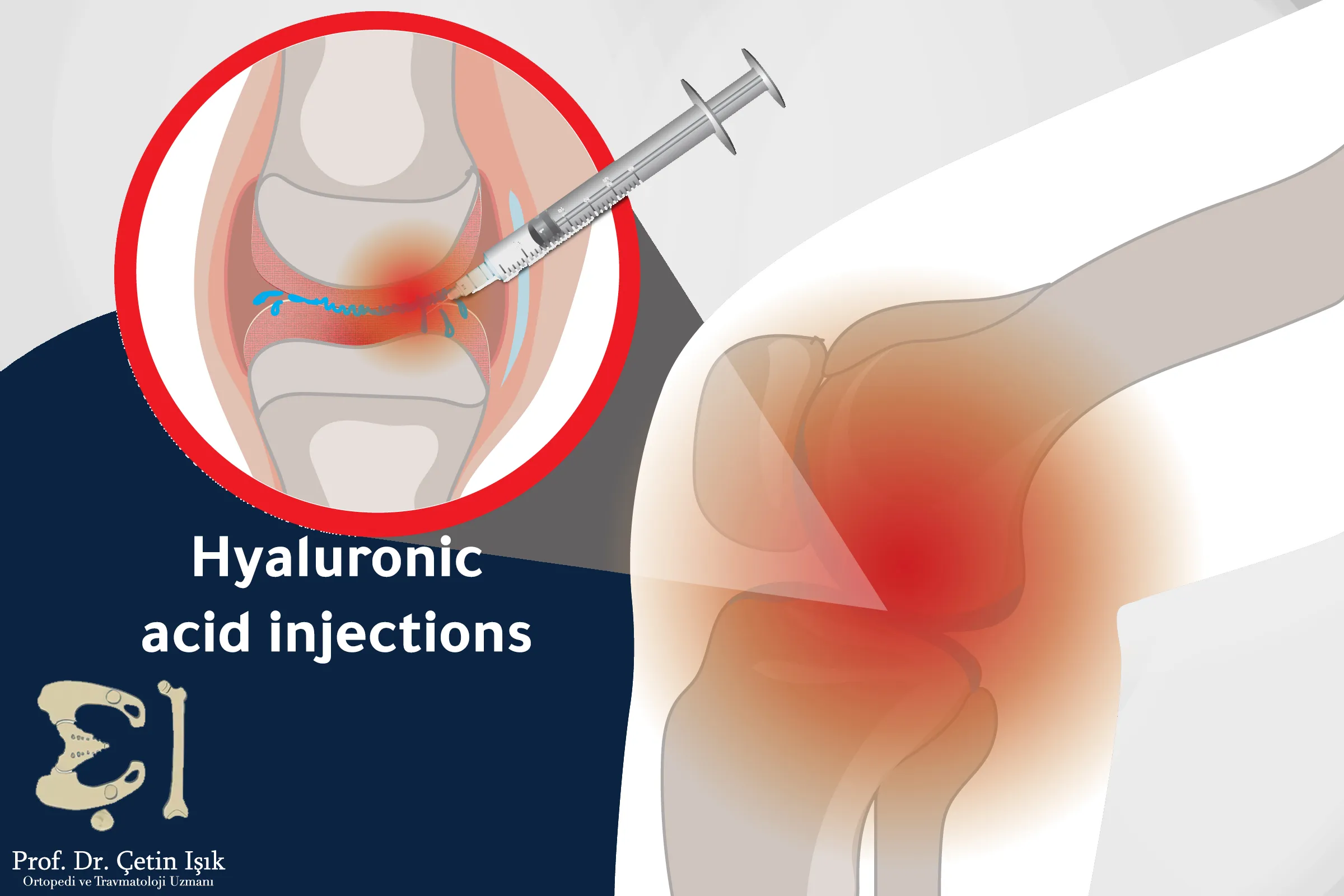 Hyaluronic acid injections help relieve pain and joint stiffness