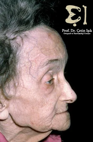 We notice an enlargement of the scalp veins in a patient with Paget's disease of bone and anterior enlargement of the head.