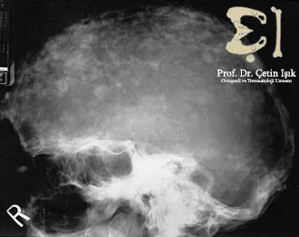 X-ray of the skull of a patient with Paget's disease of bone.
