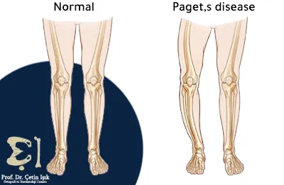 Picture of the difference between a normal leg and Paget's disease, in which the long bones are bent