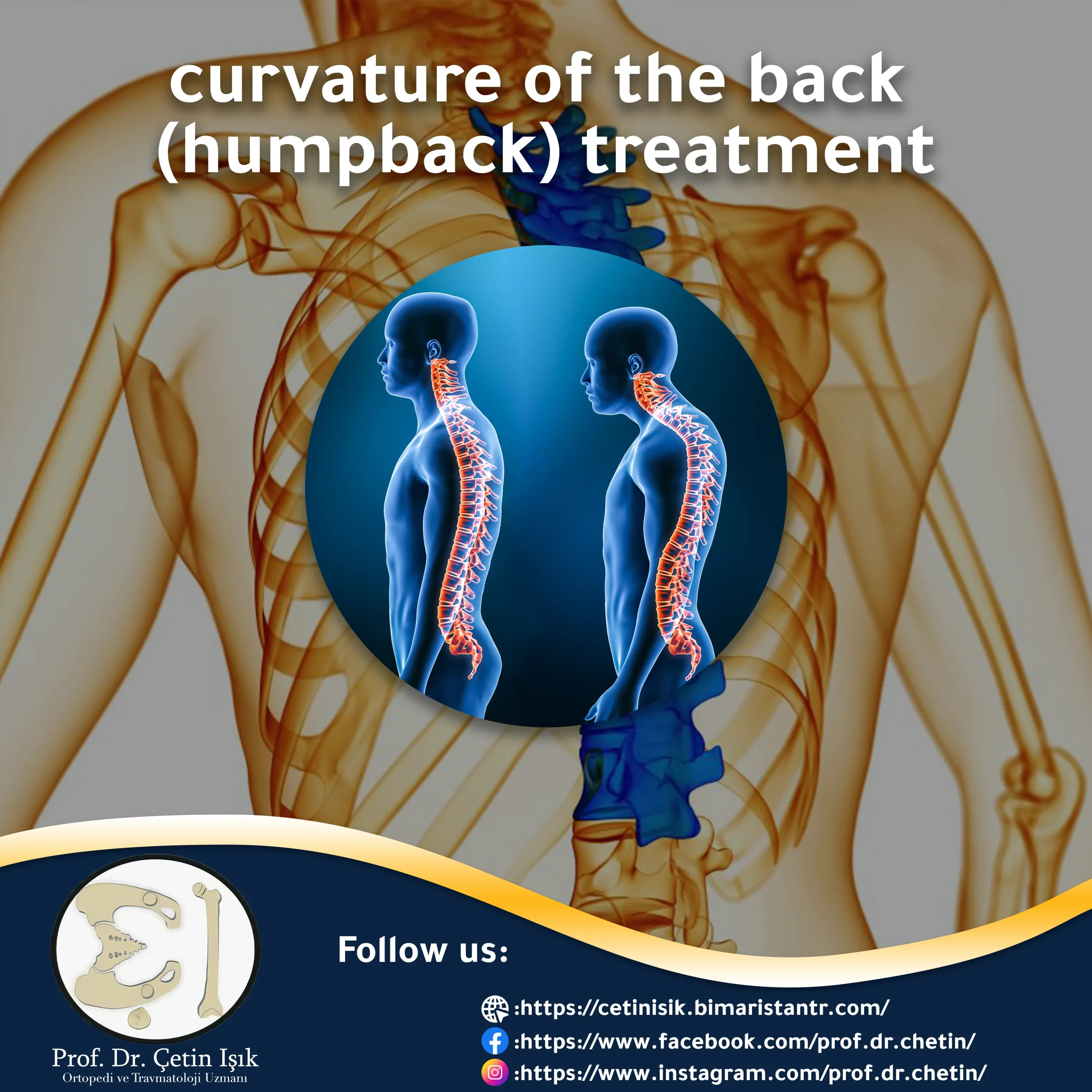 Curvature (kyphosis) treatment