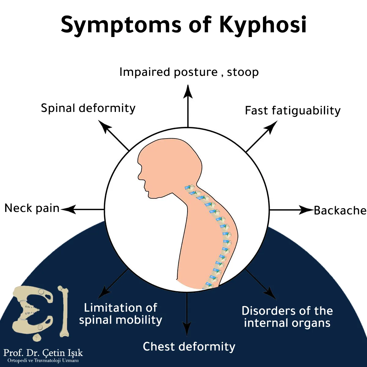 the symptoms of kyphosis such as fatigue, neck and back pain, deformation of the spine, limiting its movement, and disturbances in the internal organs.
