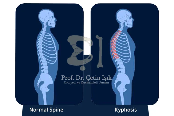The difference between a normal spine and a curvature of the back (kyphosis)