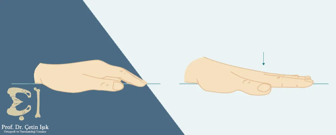 The finger stretch exercise is performed by placing the hand on a flat surface with the palm of the hand touching this surface and extending the fingers as much as possible