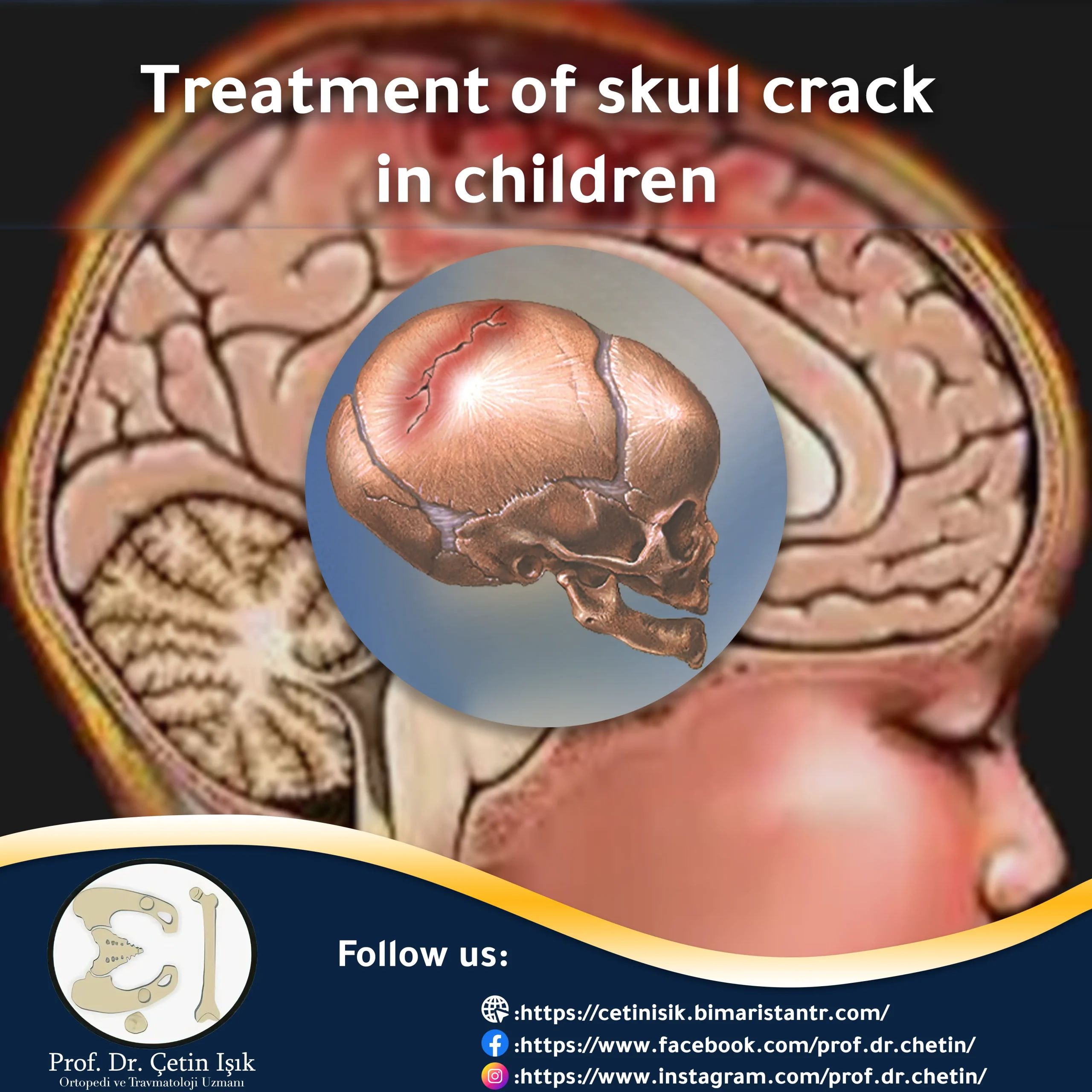 Treatment of skull fracture in children in detail