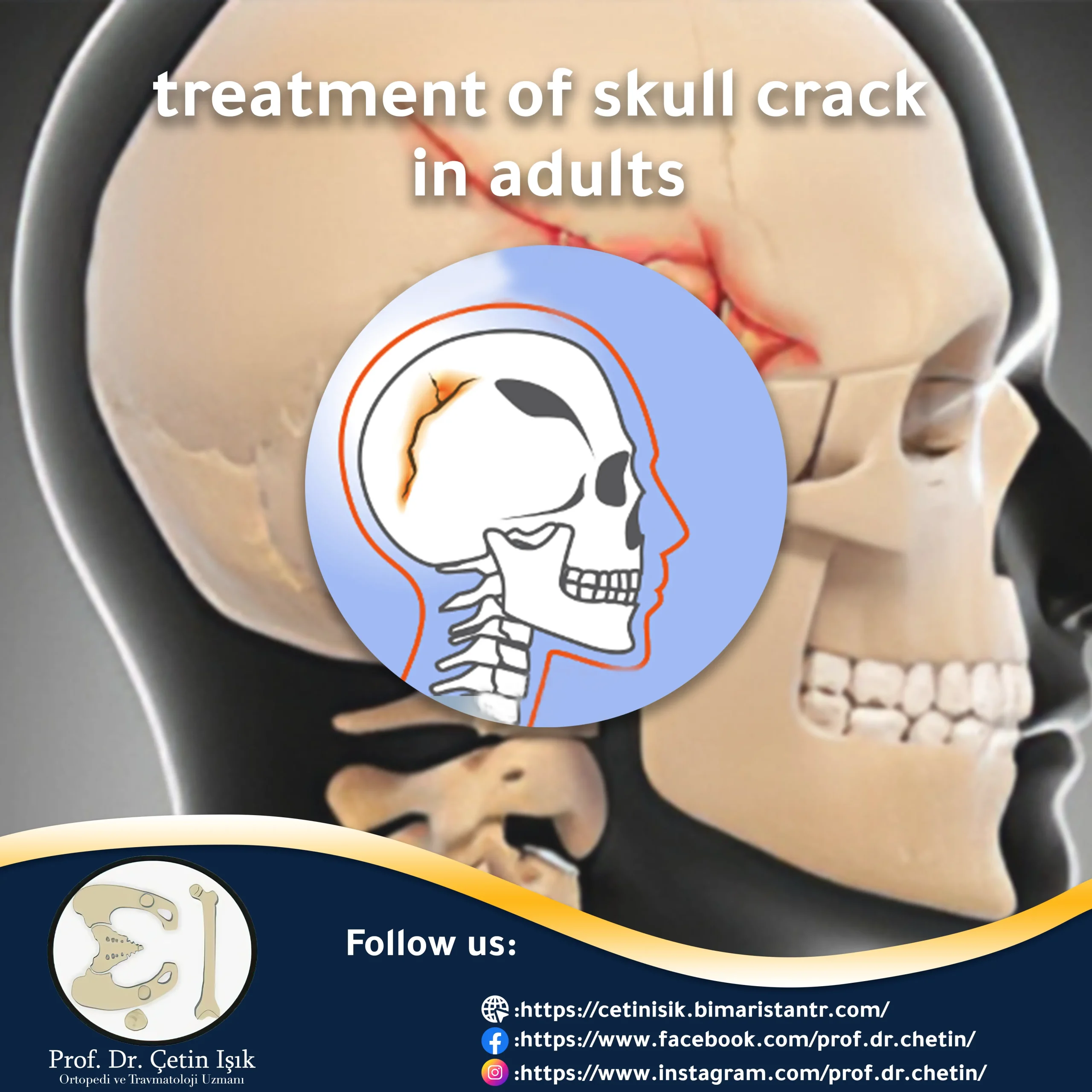 Treatment of skull fracture in adults step by step