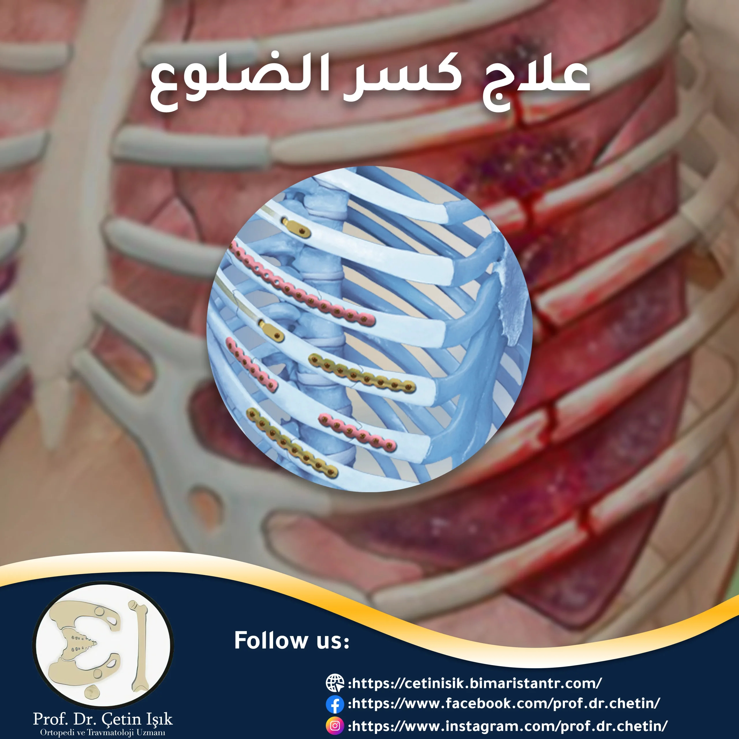 علاج كسر الضلوع – علاج محافظ أو جراحي