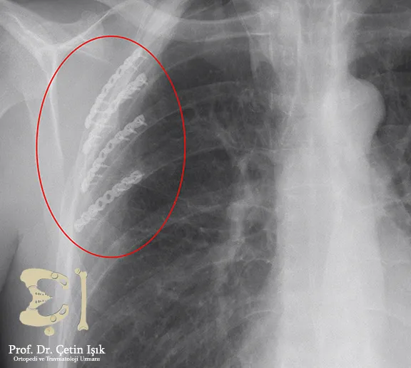 From the radiograph, we can see how to fix the broken ribs with titanium plates fixed by special screws and restore the shape of the rib cage to its normal shape.