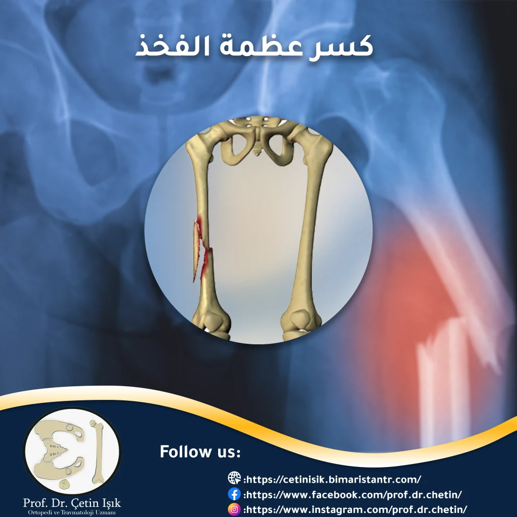 Cover image of a femur fracture