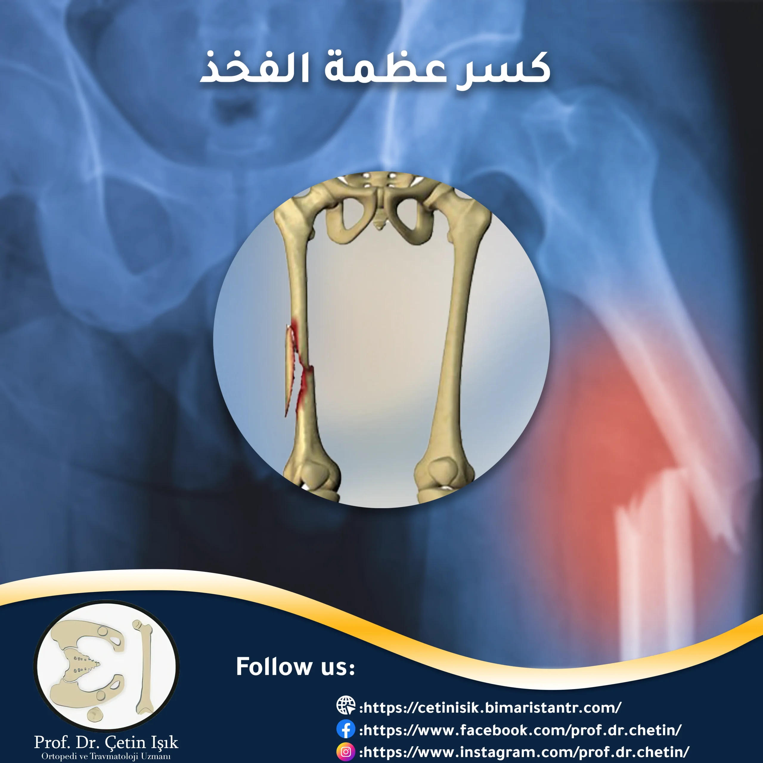 femur fracture; Your comprehensive guide