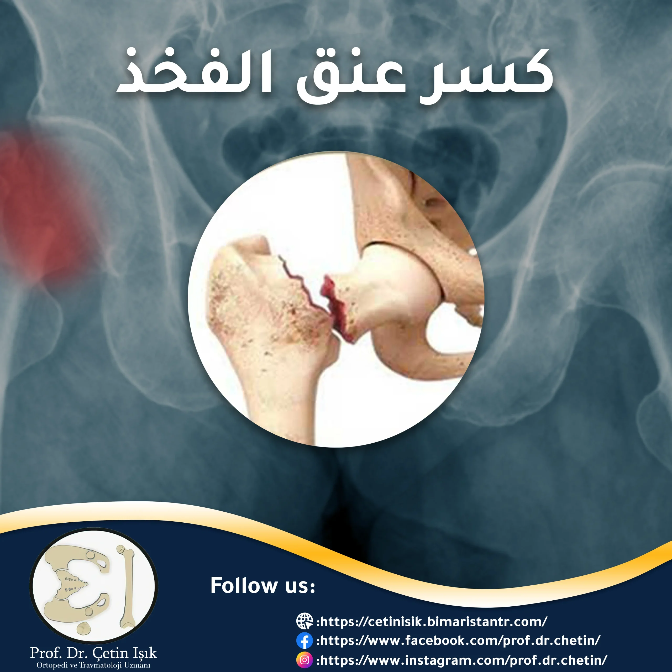 Femoral neck fracture; How to diagnose and deal with it