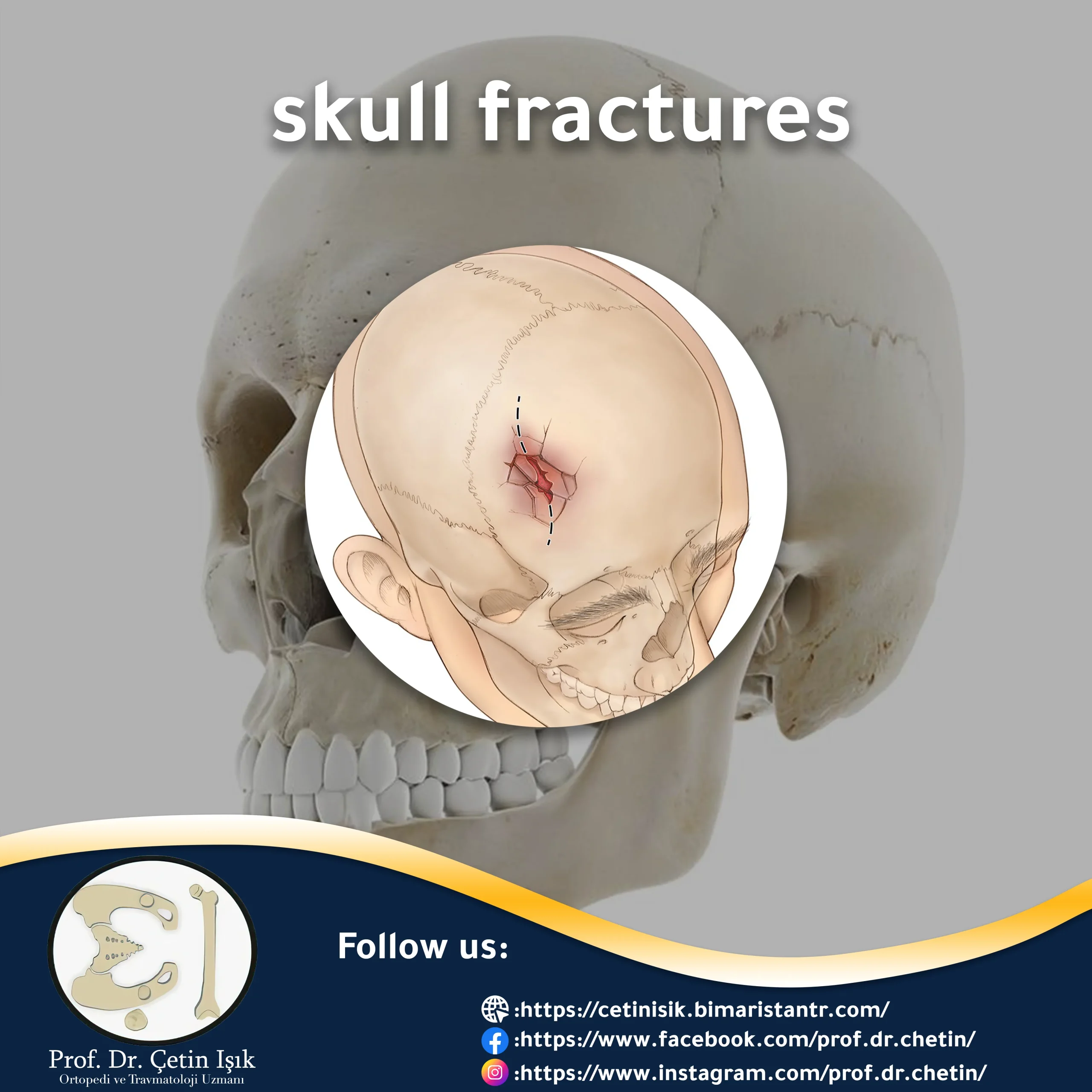 Skull fractures - the main symptoms and methods of treatment