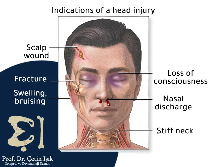 We note from the picture that the symptoms of skull fractures vary according to the severity of the injury, but the most important of them are loss of consciousness, runny nose, swelling, bruises and wounds in the scalp