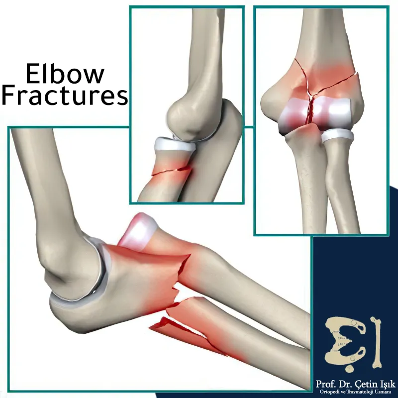 The photo shows some locations of the elbow fractures