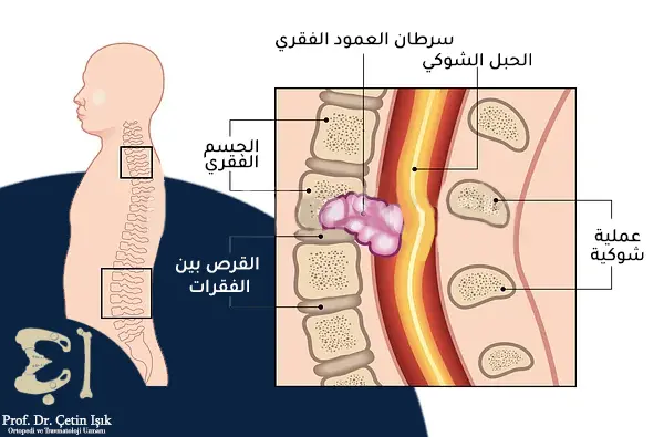 We note the spread of cancer within the vertebral bodies and its pressure on the spinal cord, which leads to symptoms